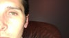 View of the left ear. Same problem. Appears to be too aggressive with trying to create an anti-helical fold that already existed and ended up folding it back too much right in the middle of the ear. Seems quite unsightly to me.