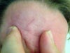 My Atropic Scar