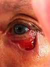 juvaderm/vitrase injection site left eye area