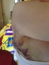 This is the Hematoma @ day 4 before the Dr drained it. It still continues to drain but more of a light yellowish liquid. Gross! I no longer have that bump or bruise but a  slightly smaller than dime size hole. Im freaked out! Please help before my next app so I can sleep.