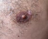 The actual scar on my nipple