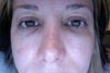 before current procedures - 1 yr. post-op mid face lift.