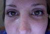 2.5 weeks after quad bleth, cheek implants, co2 laser, and mid-face touch up