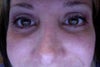 2.5 weeks after - smiling to show creepy skin under eyes