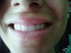 My plastic surgeon said I must have had this line before but I know myself very well and I know for a fact I never had this line.  It is too noticable.