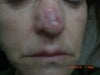 month after restylane injection