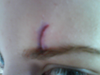 This is the injury, three years ago when it first occured. Just to show you where the position is.