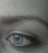 This is the healed scar. No Botox.