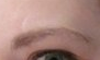 Again, No Botox. Just so you get an idea of how it looked. Botox was injected either side of scar.