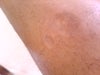 shin scar- closer look