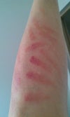 Right leg