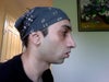 side profile AFTER surgery