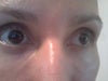 eye lumps