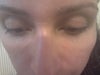 eye lumps2