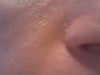 nose scars