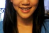 From the front--notice how my whole lower jaw is basically shifted to my right. My right (or left, in the photo) is bigger than the other side in bone size.