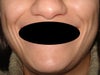 One day after the damage, ugly and older smile, today it's still like this...
