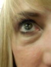 right eye bag