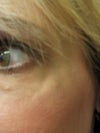 Left eye lump