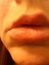 Lips uneven