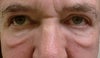 This pic probably shows the malar bags- festoons best because of the lighting. I hate the droopy look which makes me look old and tired. It seems like the scar with a direct excision would be a couple of inches long- from medial canthus to lateral canthus??