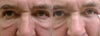 On the right, I have taken a q-tip and pulled the skin to the side as one of the doctors did in the office. The doc said the canthal angle would be slightly narrower than I show as it needs to be on the eye itself and it look like in the picture it is slightly lateral?