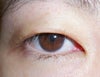 Right Eye 15 days