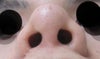 I have asymmetrical nostrils, the upturned tip and shapeless