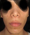 CHIN IMPLANT size L, (from hanson medical inc)
feel frozen and hard.l
i like how it looks in profile, but the front looks like a mouth proctetor.

i feel my nose a bit short for my face.
