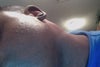 bruising and swelling inside rim of ear