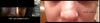 Left: Nose 6 months after my 3rd nose surgery.  Bumps and dents started appearing about 1-2 months after this was taken.  Right: Nose after my 4th surgery.  Taken 7 months after previous photo.  Dents are getting progressively worse.