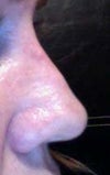 Nose from right side
