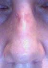 Nose from front