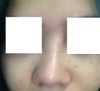 revision rhinoplasty, bridge is a lot higher when viewed from the side