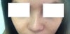 revision rhinoplasty, bridge is a lot higher when viewed from the side