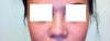 First rhinoplasty operated 5 years ago