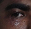 Eye lid Deformity