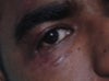 Eye lid deformity