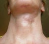 lump at 14 days postop. given cortisone shot. pic taken by digital camera--lump is on left side of neck
