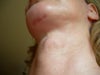 lump at 6 weeks post op