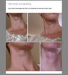 lump at almost 9 wks postop. general neck swelling has decreased but not lump after 6.5 wks of treating it with 2 cortisone shots. (shots taken with laptop--lump on left side)