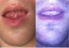 at 1wk and 3 wks after surgery