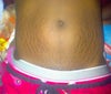 Stretch marks.