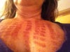 Another shot of chest on day 4