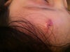 Attached here her picture 7 days after the incident, now its been 1 month it looks totaly closed and exactly like my small finger print red / pink color.