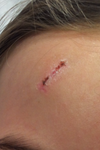 2 week post injury, 1 week after stitches removed