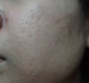 acne scars