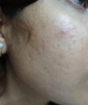 acne scars