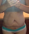 Three Weeks Post Op Front