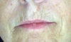 Age 64. Sun damage plus forty years of smoking cigarettes (I did quit).